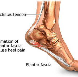 osteopathy and Plantar Fascitis