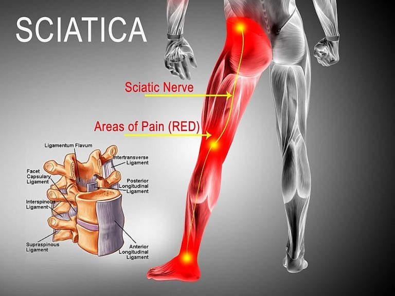 osteopathy for sciatica and trapped nerve