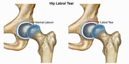 Hip Labral tear osteopathy