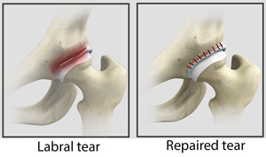 Hip Labral Tear Osteopathic Treatment